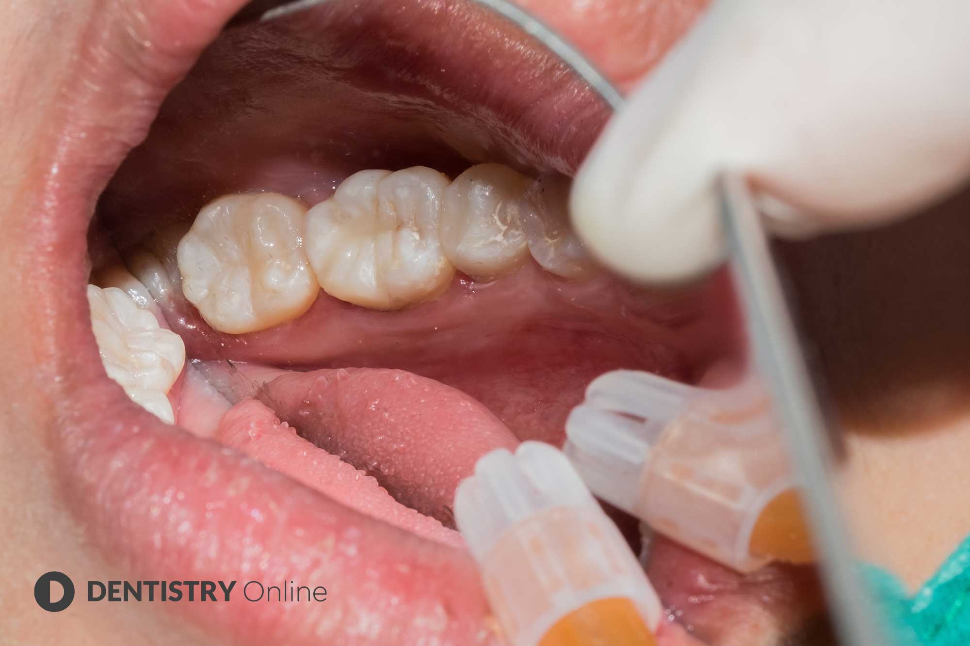 Fillings & Restorations