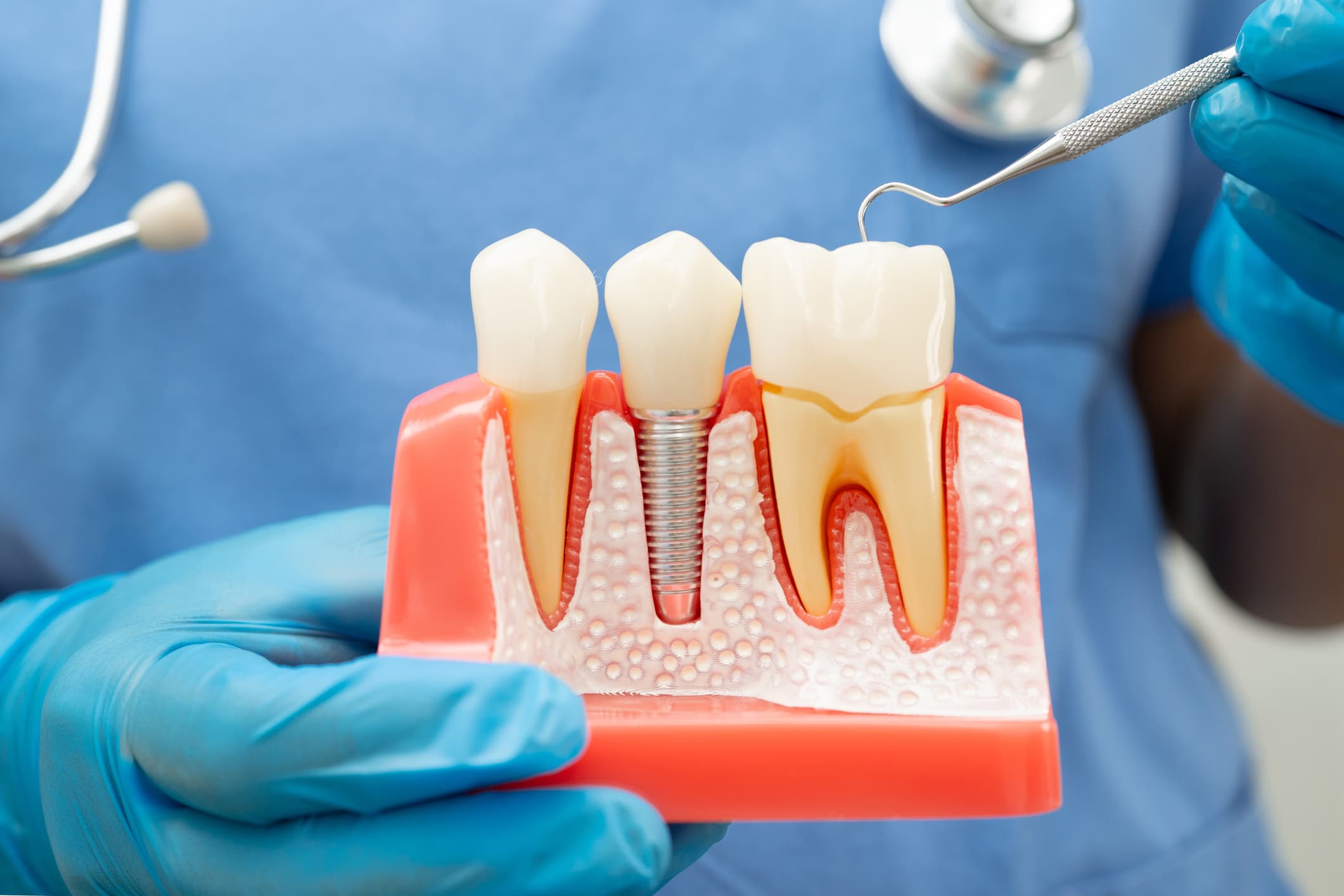Dental Implants